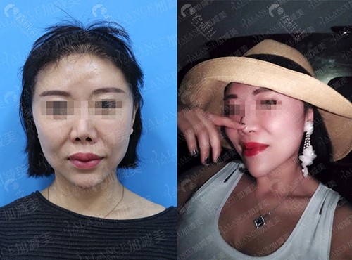 北京加减美面部提升改善法令纹效果照片