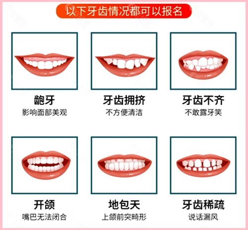 错颌畸形常见的几种类型