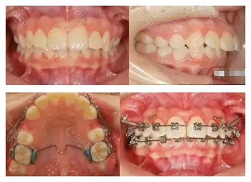 南阳市口腔医院牙齿矫正前后变化对比图