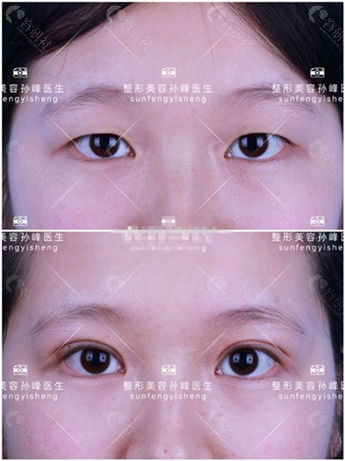 西安孙峰割双眼皮前后对比照片
