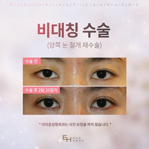 韩国EH爱护医院朴炳浩双眼皮修复前后对比照片