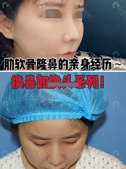 南京美贝尔美容医院肋软骨隆鼻术后效果