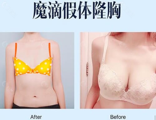 韩国普罗菲耳假体隆胸术前术后对比