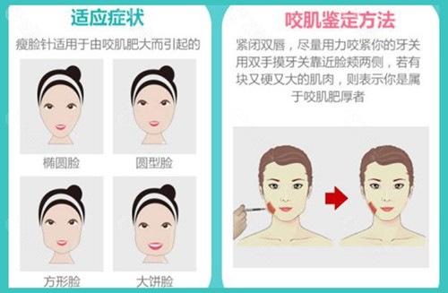 瘦脸针可以改变哪些脸型