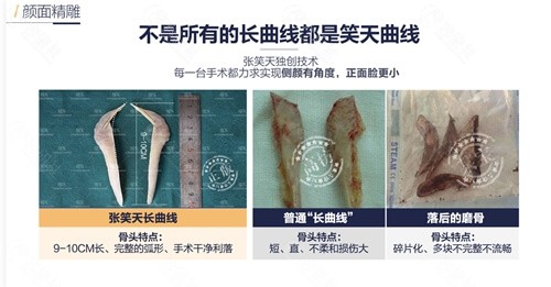北京圣嘉新张笑天医生下颌角截骨技术优势