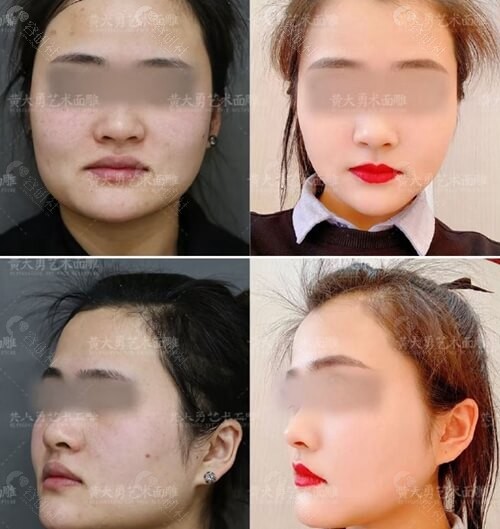 北京磨骨医生黄大勇面部轮廓手术前后对比照