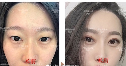 北京画美医疗美容医院任召磊医生做的双眼皮术前术后对比图