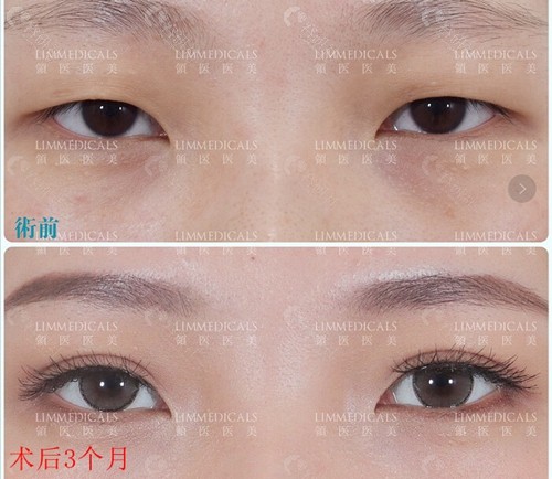 北京领医医疗美容高泽博和医生做的双眼皮术前术后对比图