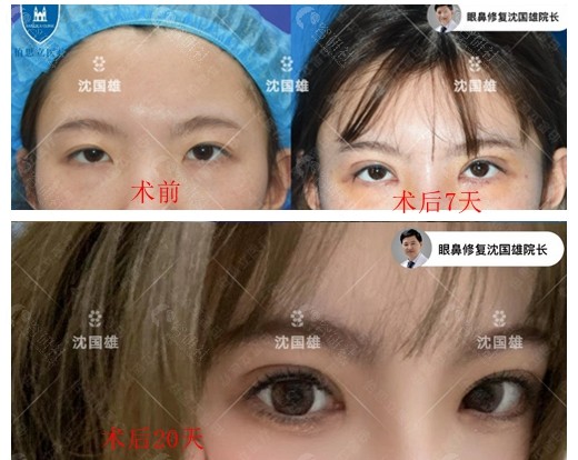 上海百达丽沈国雄医生双眼皮修复术前术后对比图分享