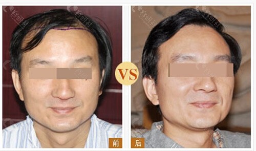 沈阳肤康皮肤病医院植发科植发前后对比