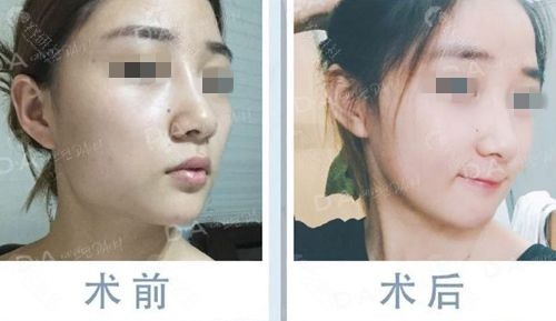 上海美联臣下颌角手术前后对比照