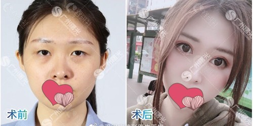 广州曙光医学美容医院王娟医生割双眼皮术前术后对比图