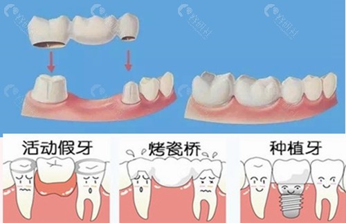 活动假牙和种植牙的区别