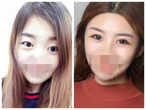 济南韩 式整形外科医院割双眼皮术后效果