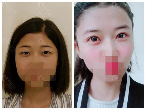 济南韩 式整形外科医院割双眼皮前后对比