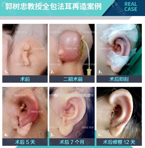 郭树忠教授全包法耳再造手术恢复过程图