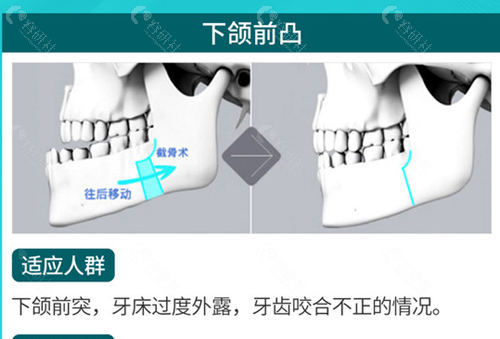 下颌前凸的矫正方法