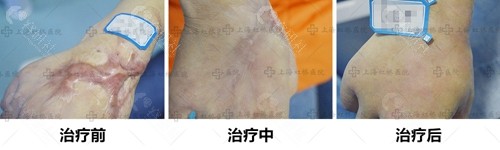 上海虹桥医院手上疤痕祛除前后对比