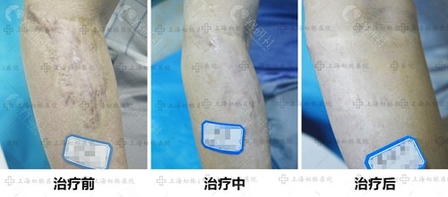 上海虹桥医院手臂疤痕修复前后对比