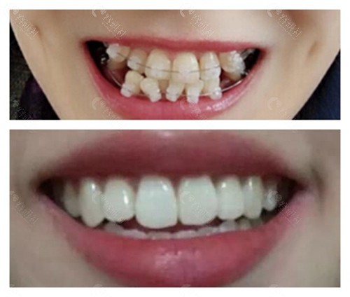 西安中诺口腔牙齿矫正前后变化对比照片