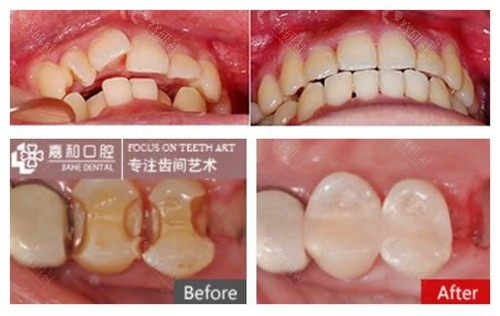 辽阳嘉和口腔牙齿矫正与补牙前后对比照片