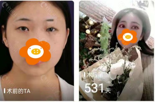 东莞美立方整形美容医院割双眼皮对比照