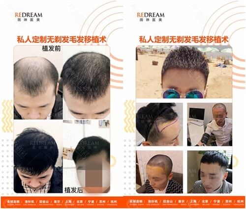 杭州薇琳植发男士头顶加密种植前后对比照片