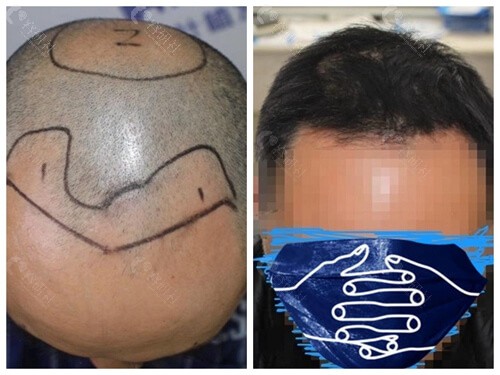 杭州大麦微针植发男士M型脱发发际线种植术后效果