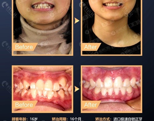 成都新桥口腔医院自锁牙齿牙套矫正前后对比效果图