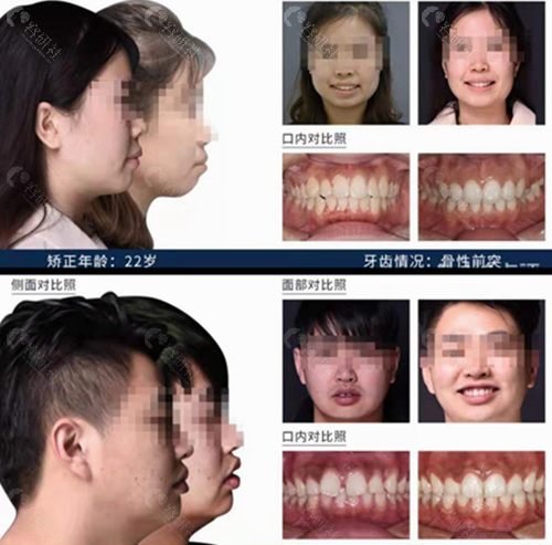 重庆牙博士口腔医院牙齿矫正对比照