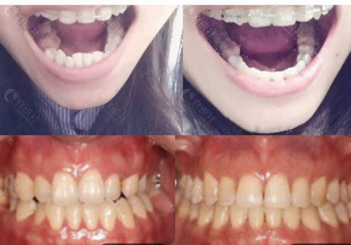 重庆牙卫士口腔医院牙齿矫正对比照