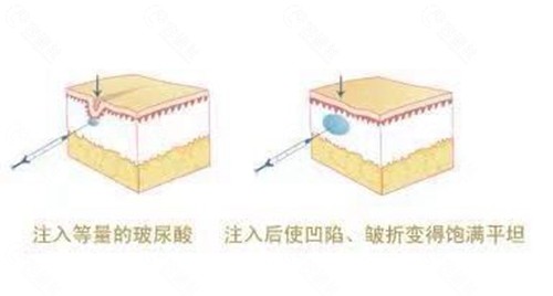 注射玻尿酸过程