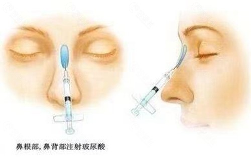 玻尿酸隆鼻注射玻尿酸位置
