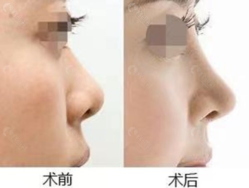 玻尿酸隆鼻术前术后对比图