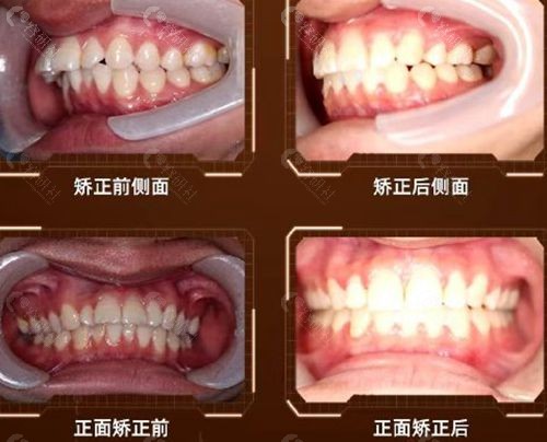 常州北极星口腔牙齿矫正前后对比