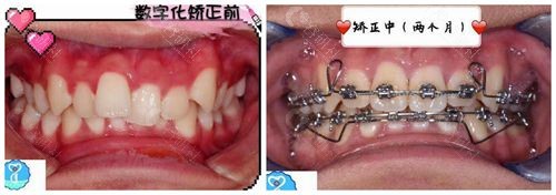 常州太平洋口腔牙齿矫正对比照