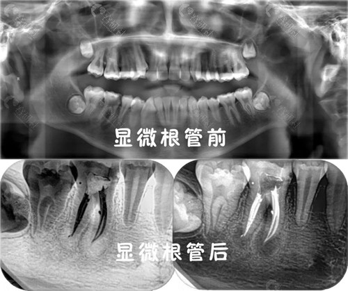 怀化唯雅口腔根管治疗前后对比照片