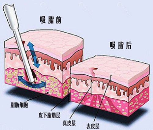 吸脂手术改变的是脂肪量