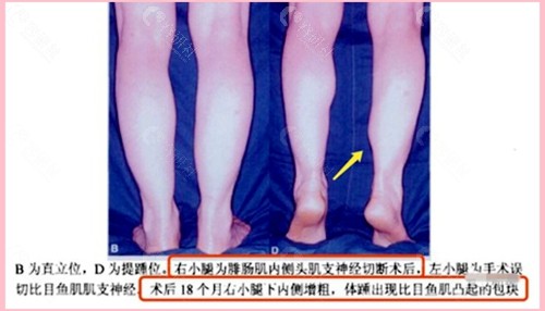 不当瘦小腿产生的危害和副作用