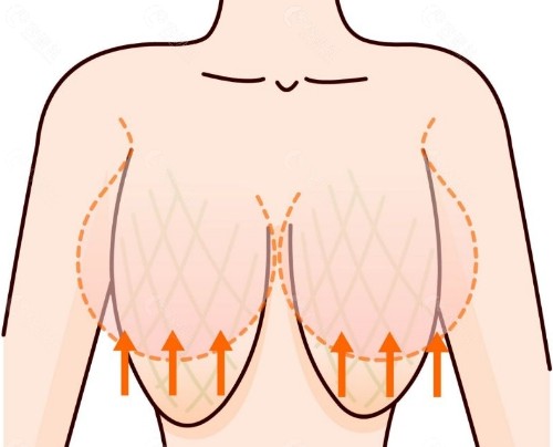 胸软下垂没弹性做假体隆胸管用吗，术后会不会留疤？