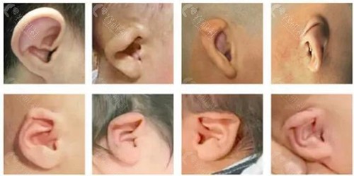 不同类型耳畸形图片