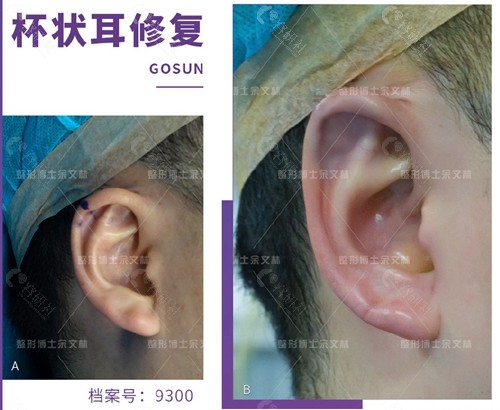广州耳再造比较厉害的医生余文林杯状耳修复前后对比照片