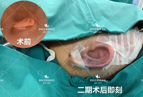 西安耳再造比较厉害的医生郭树忠小耳畸形矫正前后对比照片