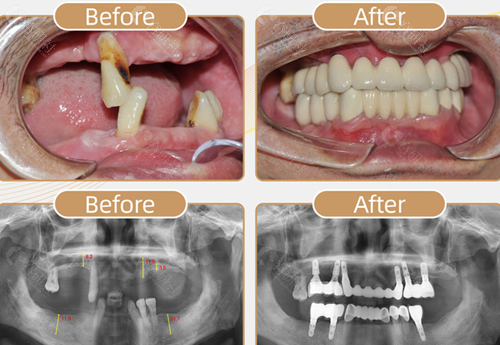 合肥佳冠口腔种植牙前后对比