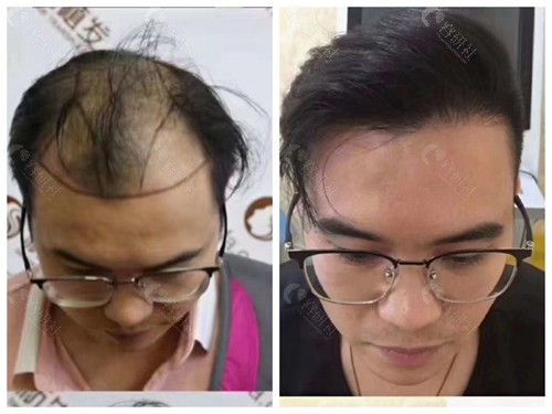 广州新生植发前后对比