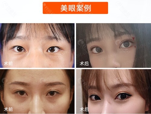 杭州薇琳医疗美容医院割双眼皮前后对比