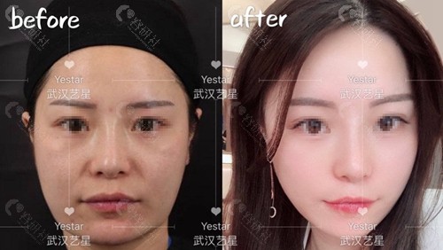 武汉艺星医疗美容医院朱胜军医生做的面部拉皮提升术前术后对比效果图
