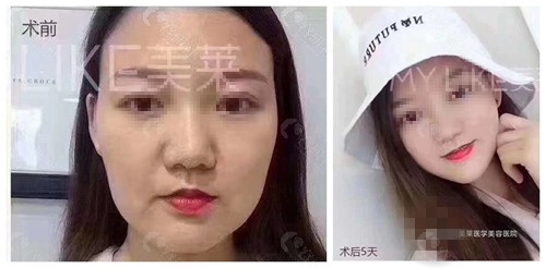 武汉美莱医疗美容医院面部拉皮提升术前术后对比图
