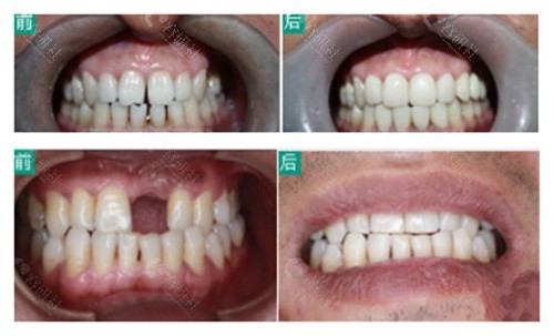 石家庄全博口腔牙齿矫正和种植牙前后对比照片