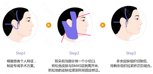 韩国珠儿丽拉皮手术方法